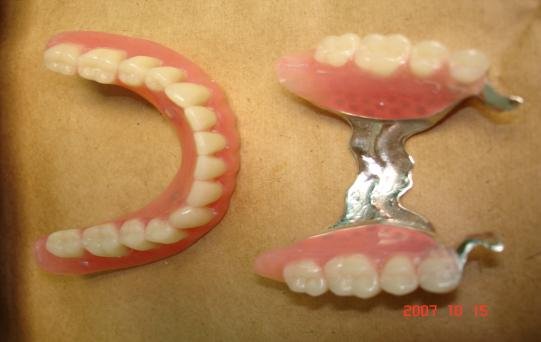 Зубной мост на крючках фото